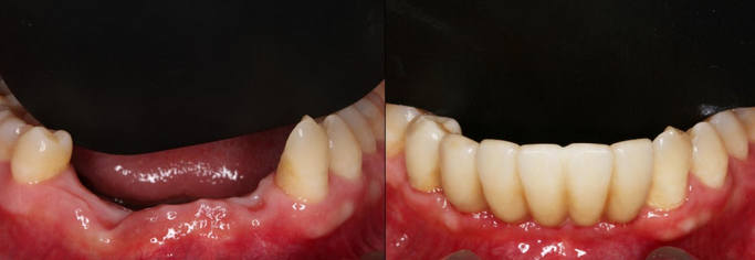 湘潭種植牙真人案例 術後三個月牙齒已經變得更加穩固1980元/顆
