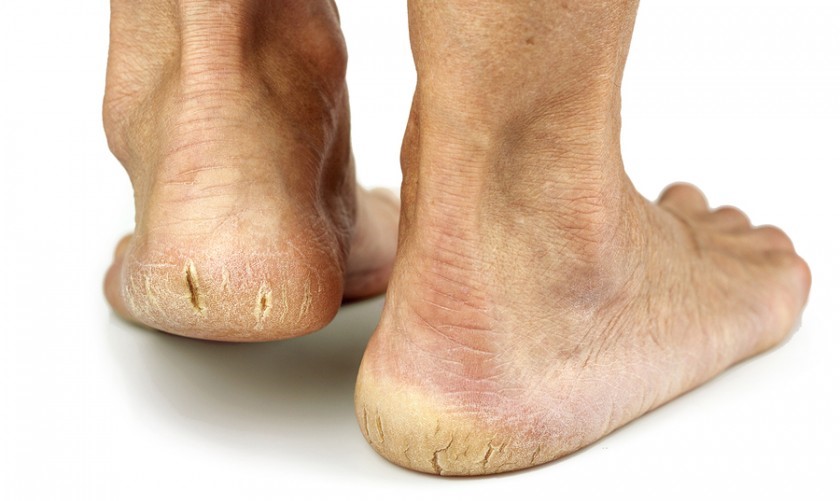 手足皲裂性湿疹由内外因素共同作用引起,治疗比较困难,容易复发