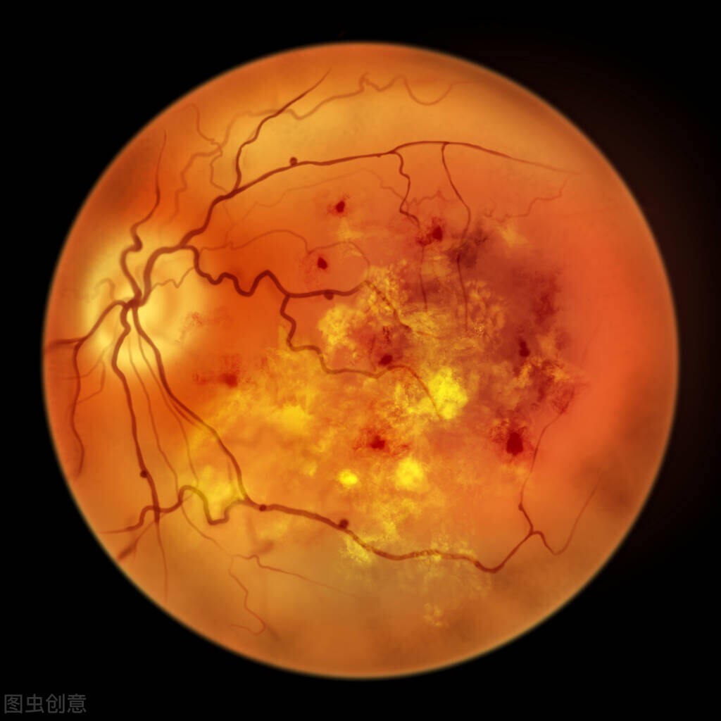 浅谈糖尿病性视网膜病变的诊断
