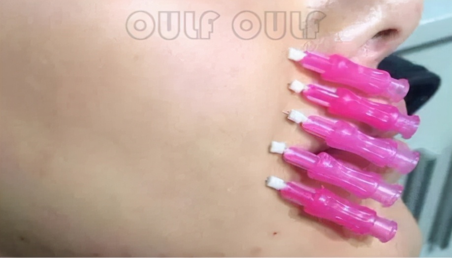 蛋白线雕有什么效果?蛋白线面部提升后遗症可怕吗