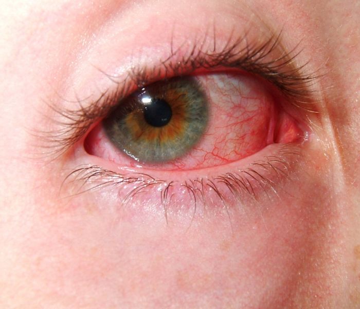 不正常眼睛的红血丝图图片