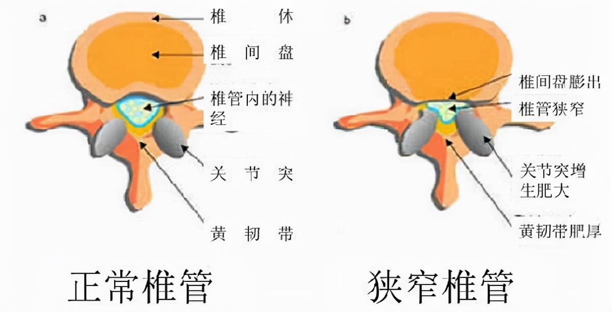 腰椎管狭窄症具有多种病因