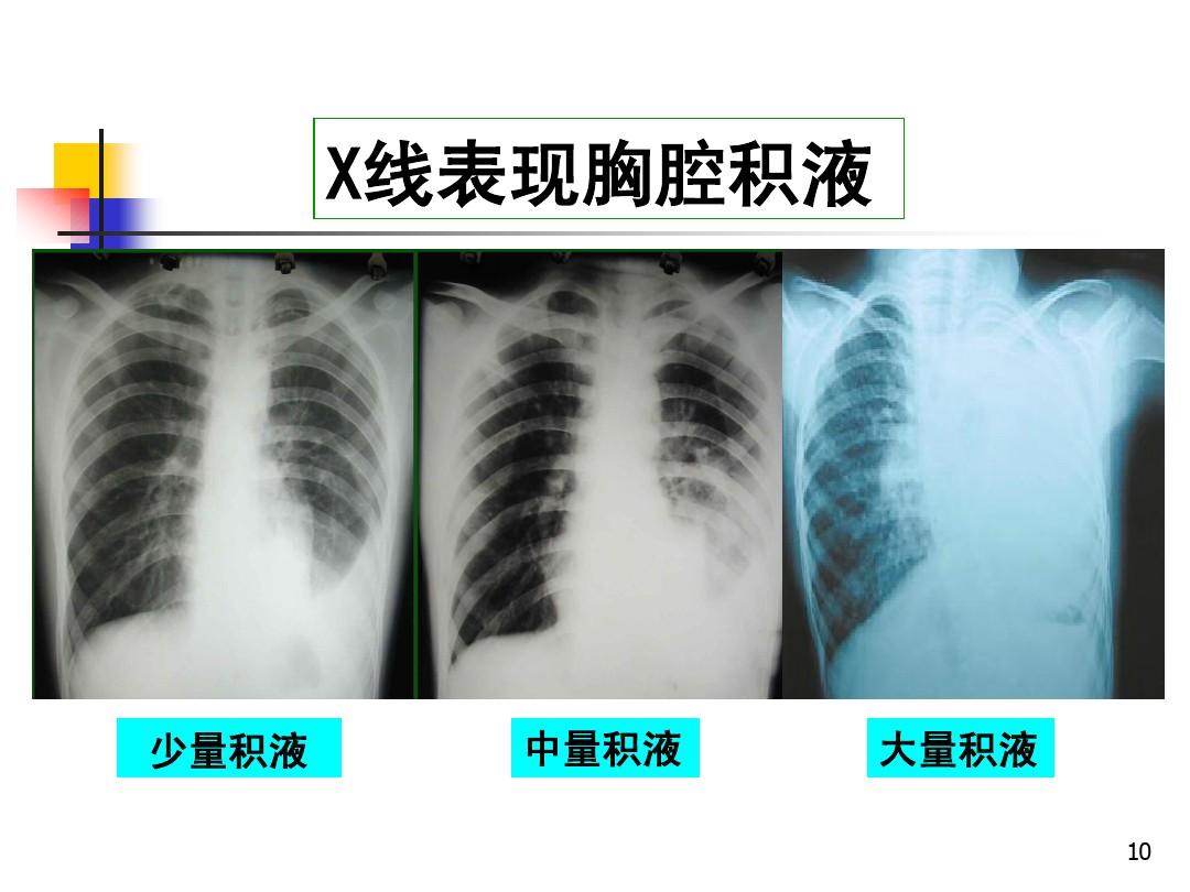 恶性胸腔积液可针对病因进行治疗,保守治疗无效,可采取手术治疗