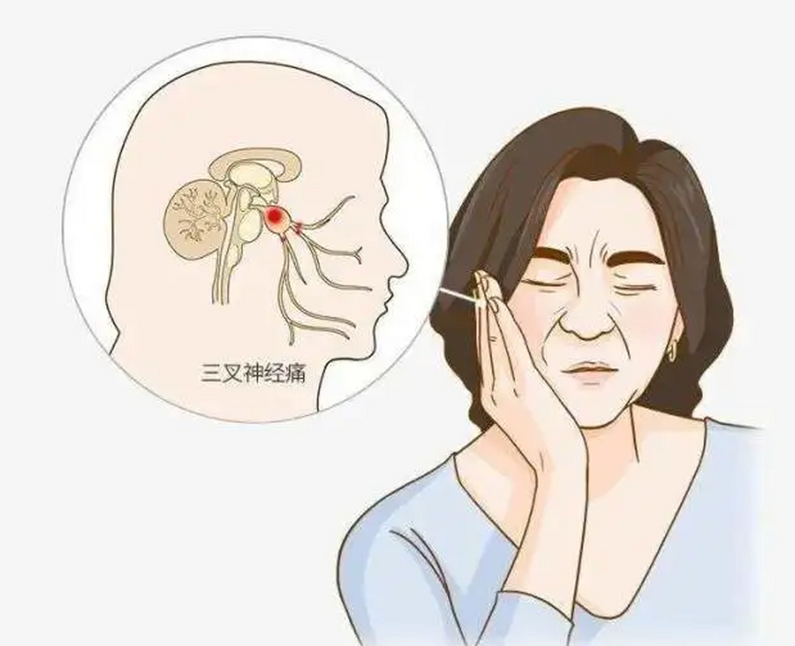 面部神经痛:常见类型和评估方法  面部神经痛是一种常见的疾病,它可以