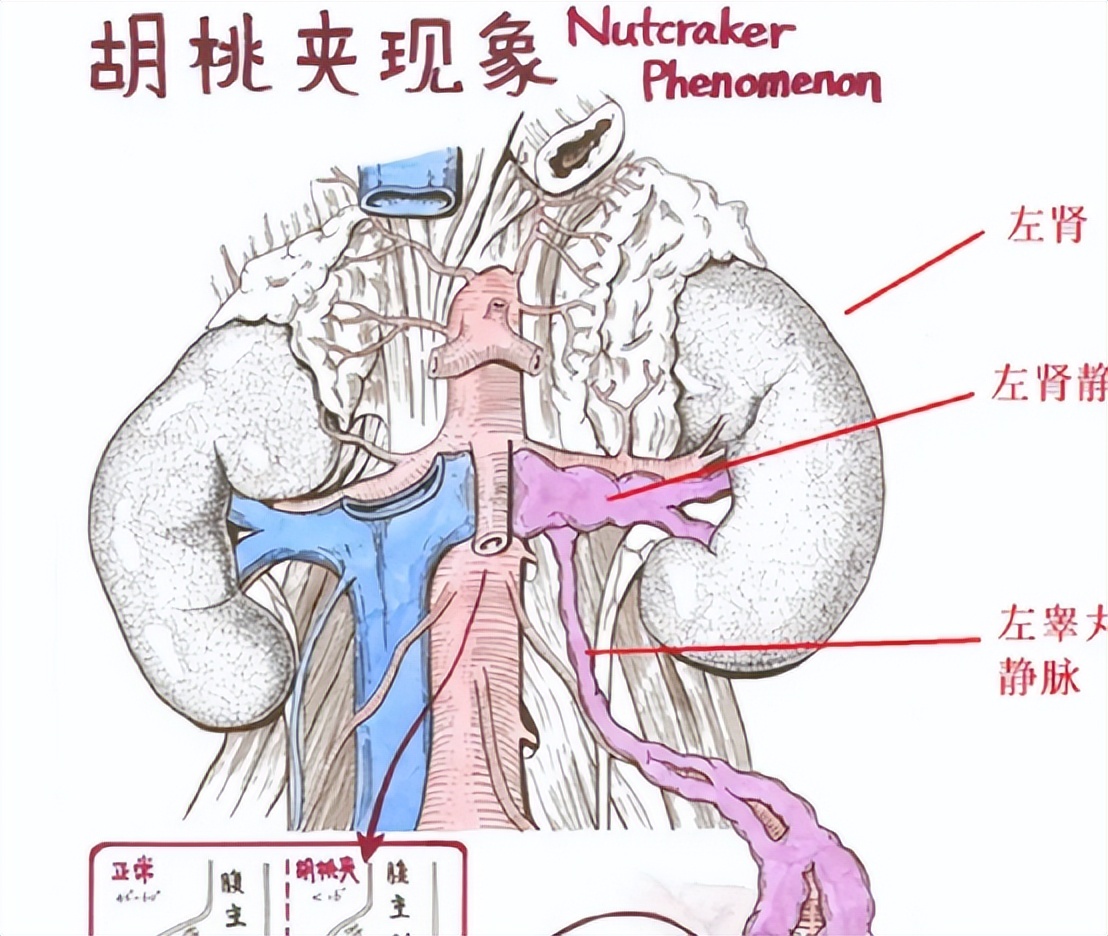 女性胡桃夹现象图片