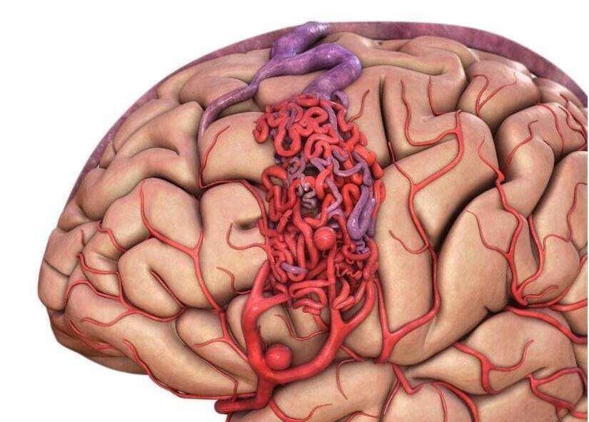 海绵状血管瘤具体病因还不清楚,患病率为1%～4%,好发于面部