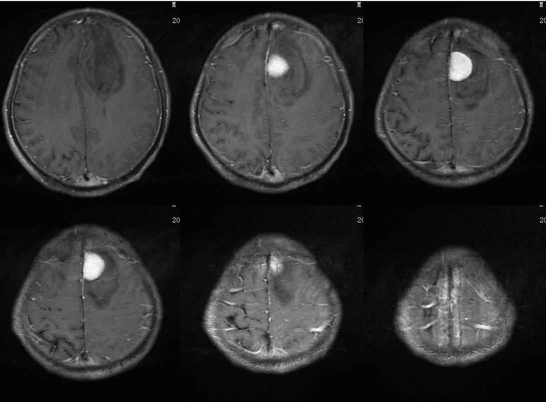 大脑镰旁脑膜瘤图片