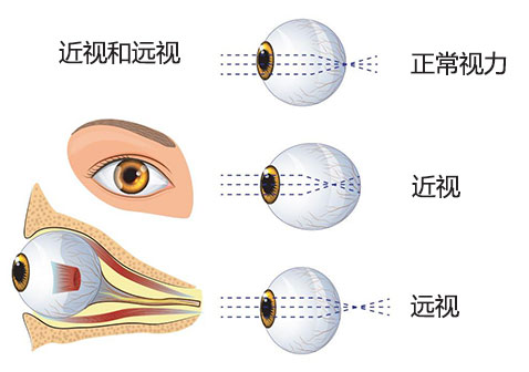 散光,近视,老花的关联性