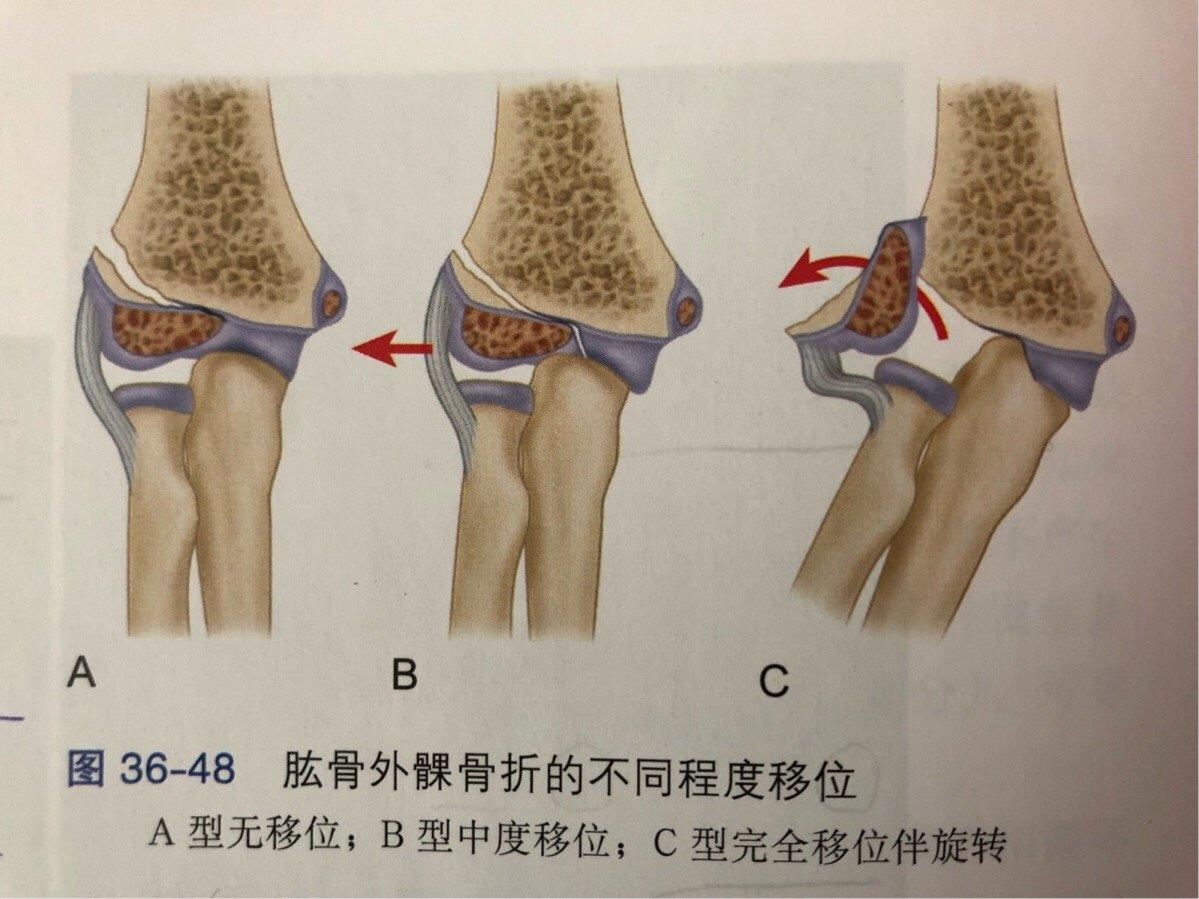 左侧肱骨外科颈骨折图图片