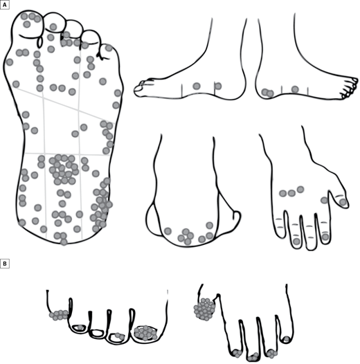 警惕这类「黑痣」癌变风险较高,最好及时切除