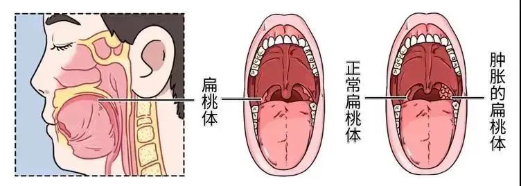 腺樣體肥大手術的最佳年齡 成都民生耳鼻喉醫院