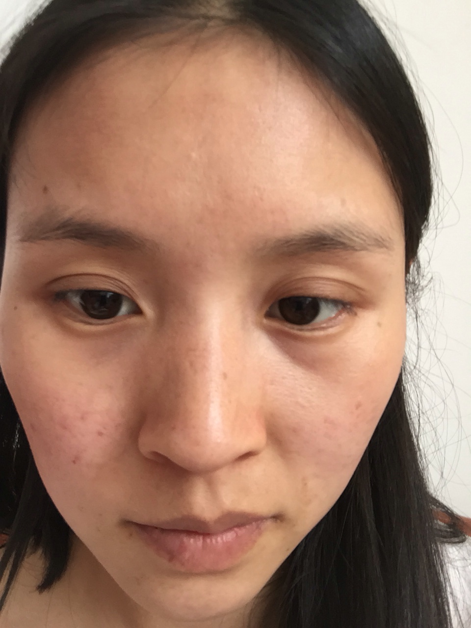 肌肤暗沉美白变黑皮,这是什么原因,选择医美还是选择护理?