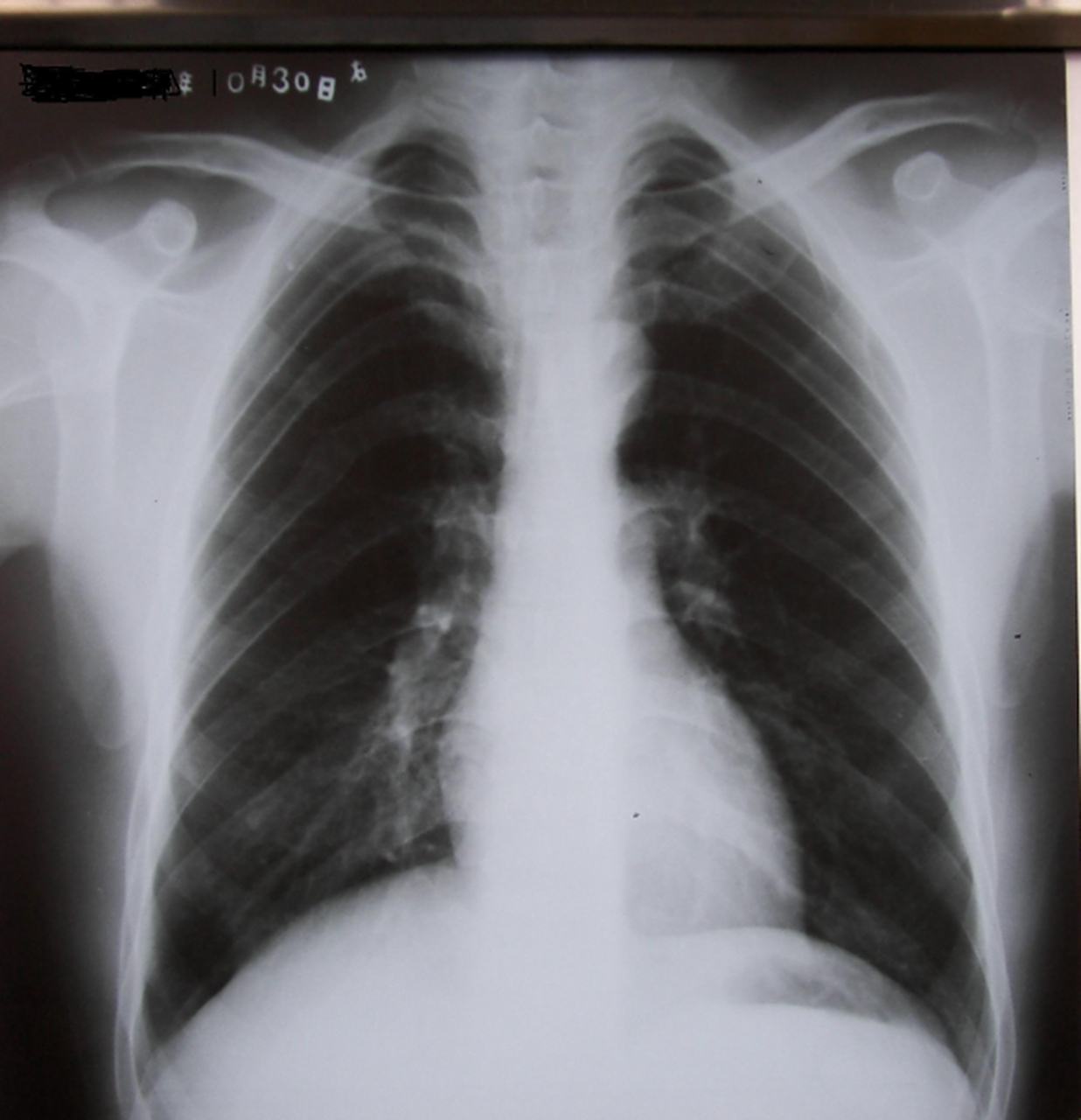 肺炎是一种常见的呼吸道疾病,冬季是其高发季节