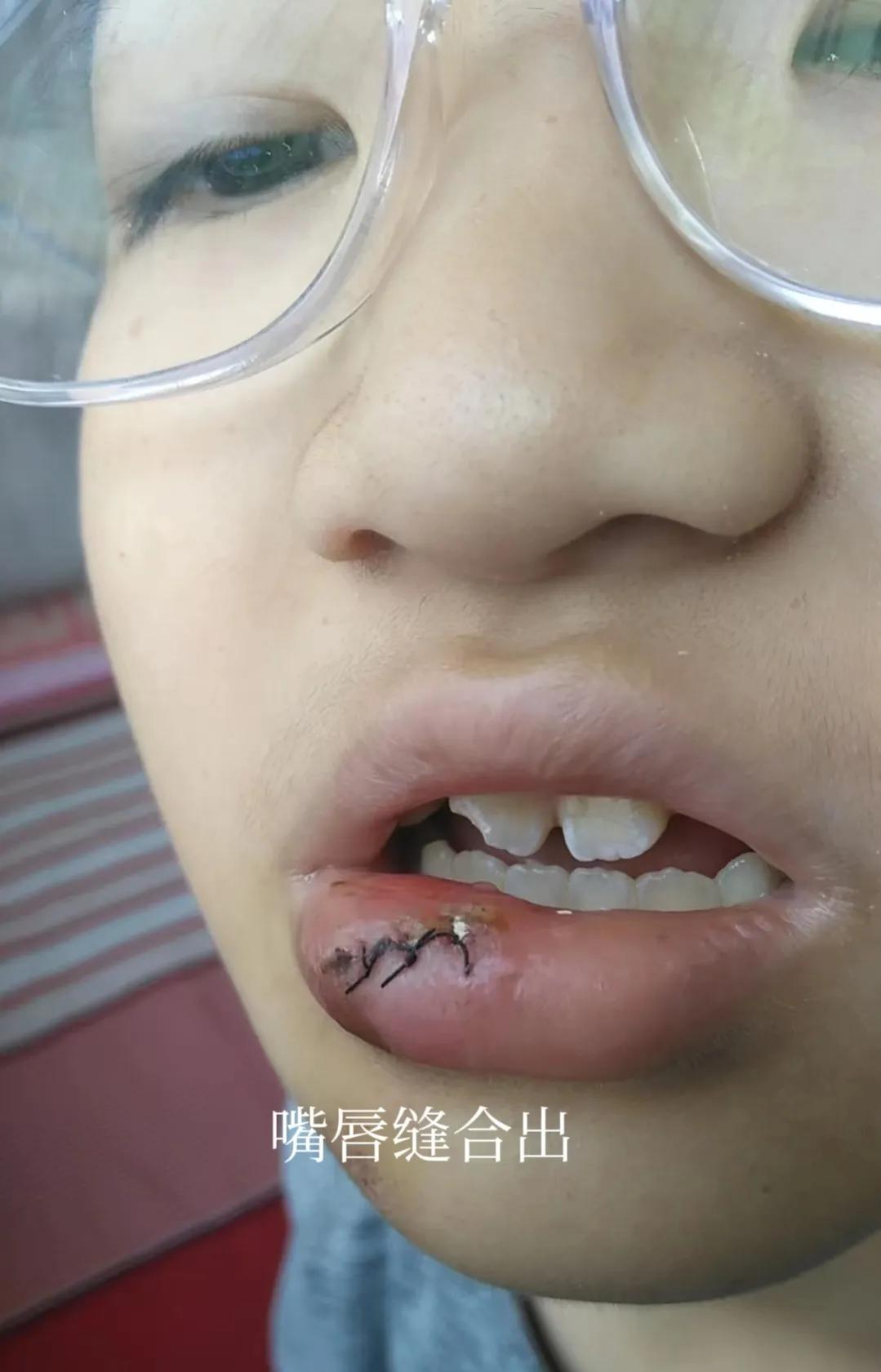 孩子在校受伤嘴唇缝三针,离石区第二小学能否给个说法,教科局呢