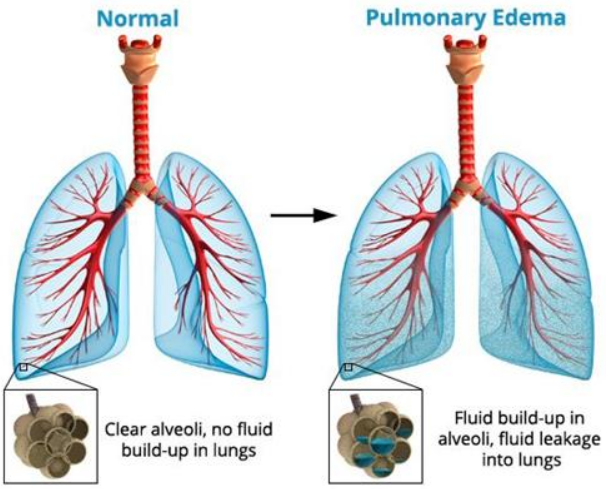 acute pulmonary edema图片