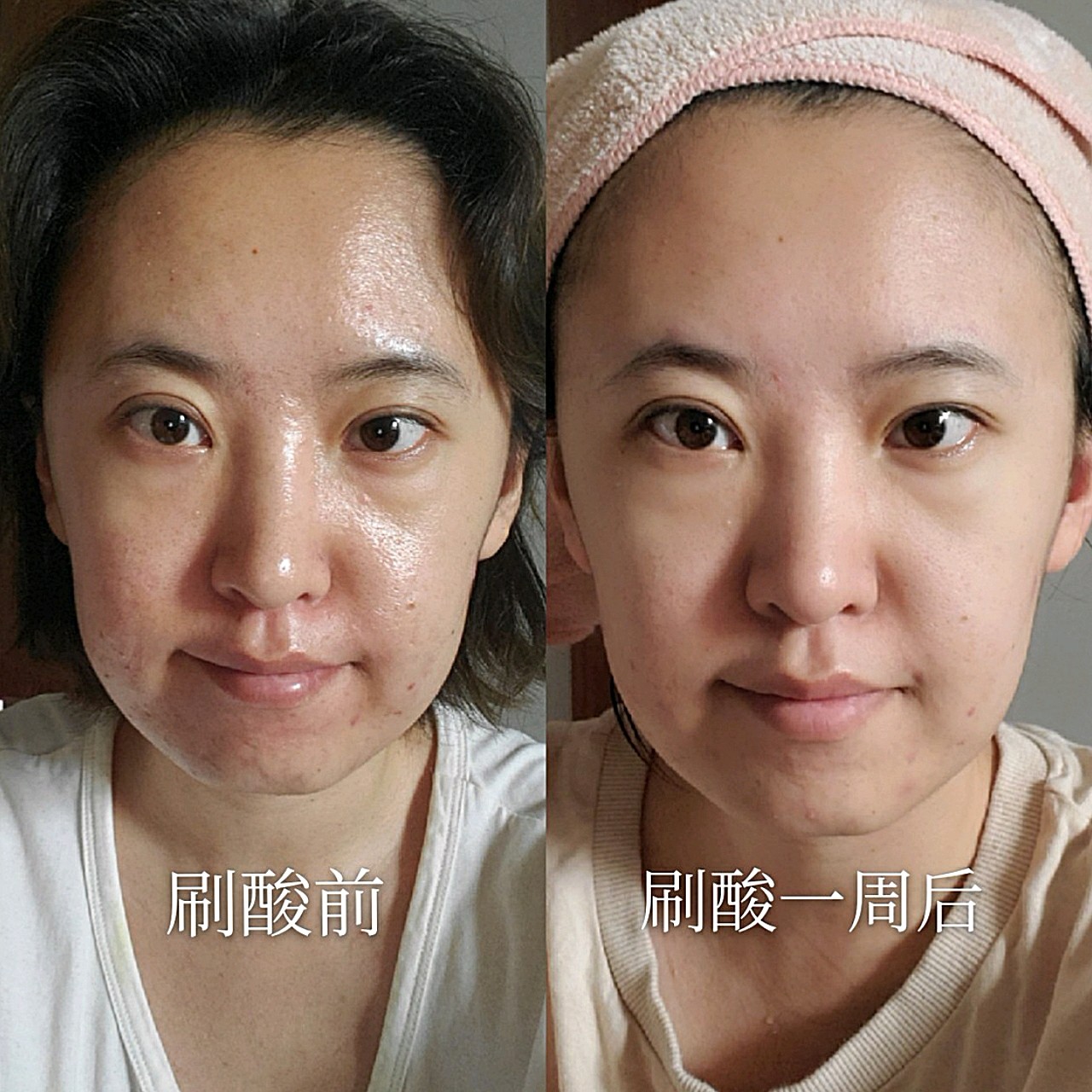 果酸换肤,真的有效果吗?刷酸有什么注意事项?