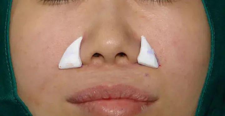 鼻基底凹陷有什么解决办法?玻尿酸和假体填充那个好?