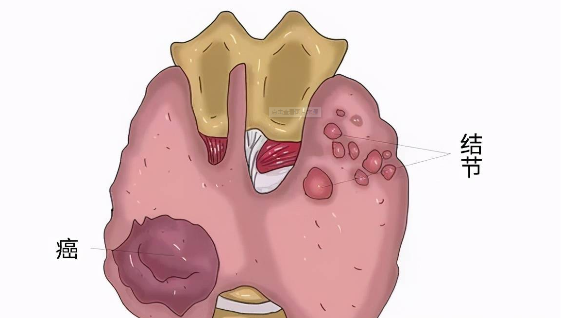 肺结节就是一坨痰