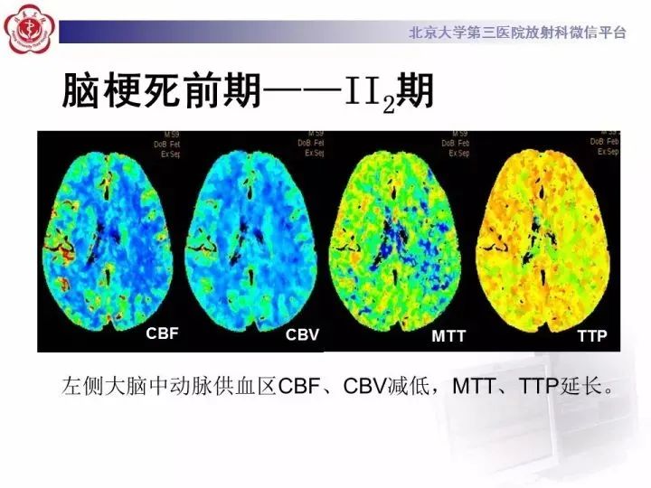 ct灌注成像图像解读图片