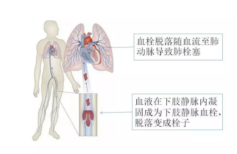 肺栓塞形成机制图片