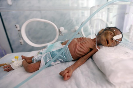 肥胖其实属于营养不良,我国青少年超重数据增长,农村儿童占比大