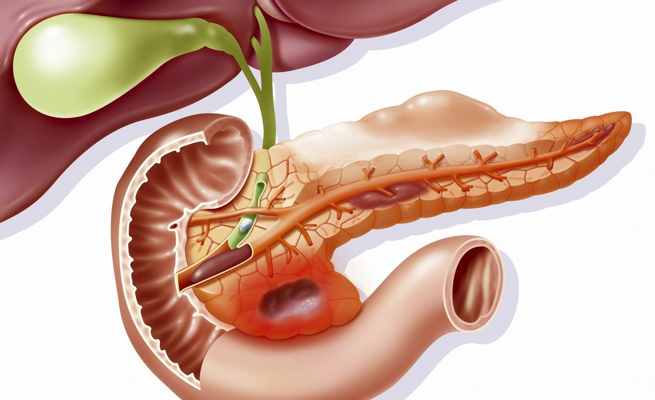原发性胆汁性胆管炎是自身免疫性肝病,病情进展迅速,治疗难度大