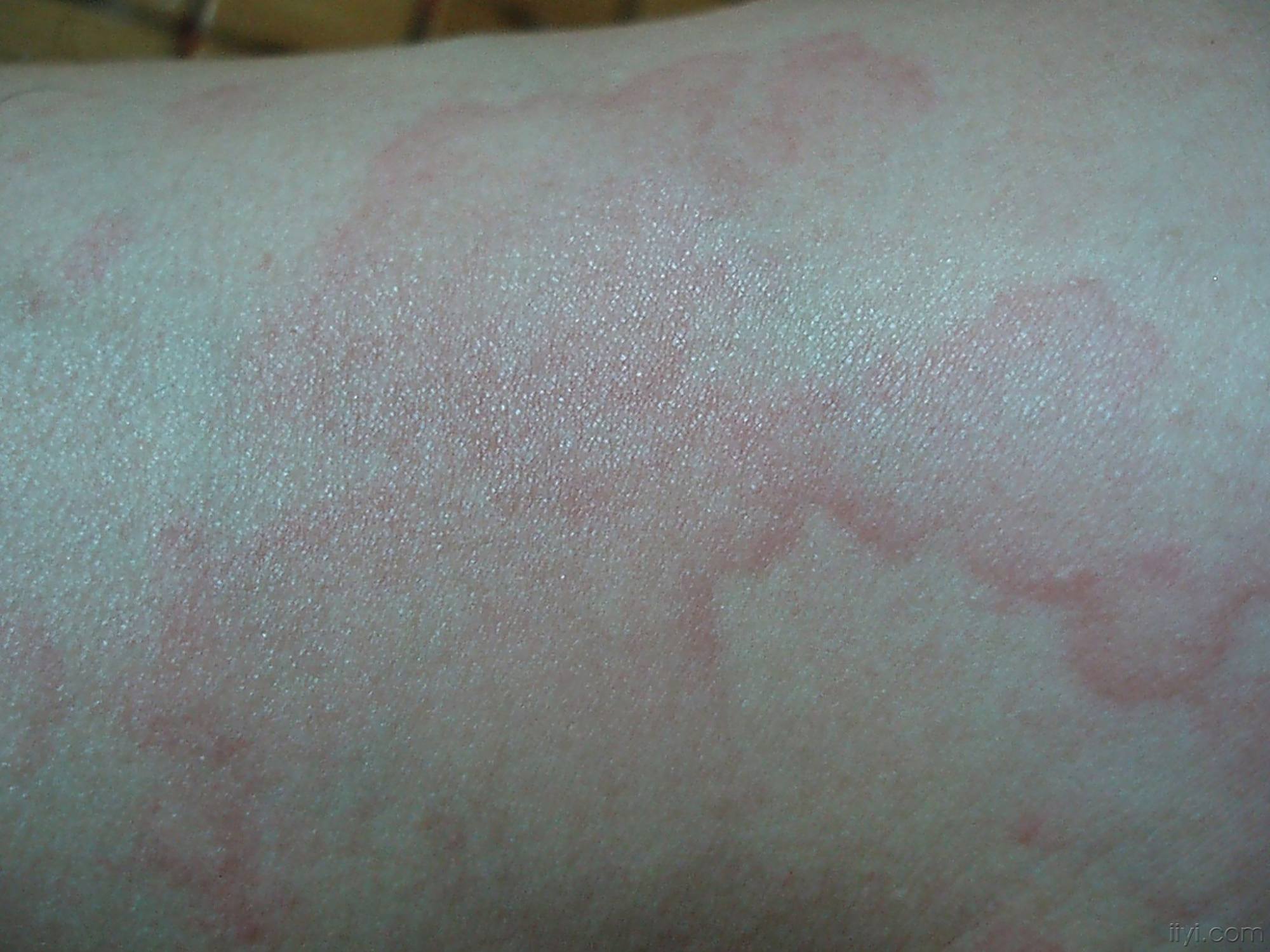 糖尿病性皮肤病种类繁多表现各异,应及时就诊,以免导致严重后果