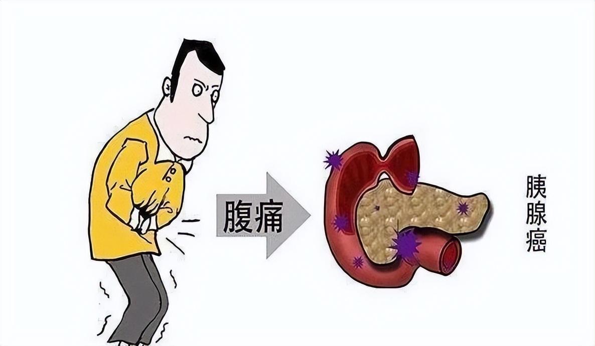 胰腺癌的症状图片