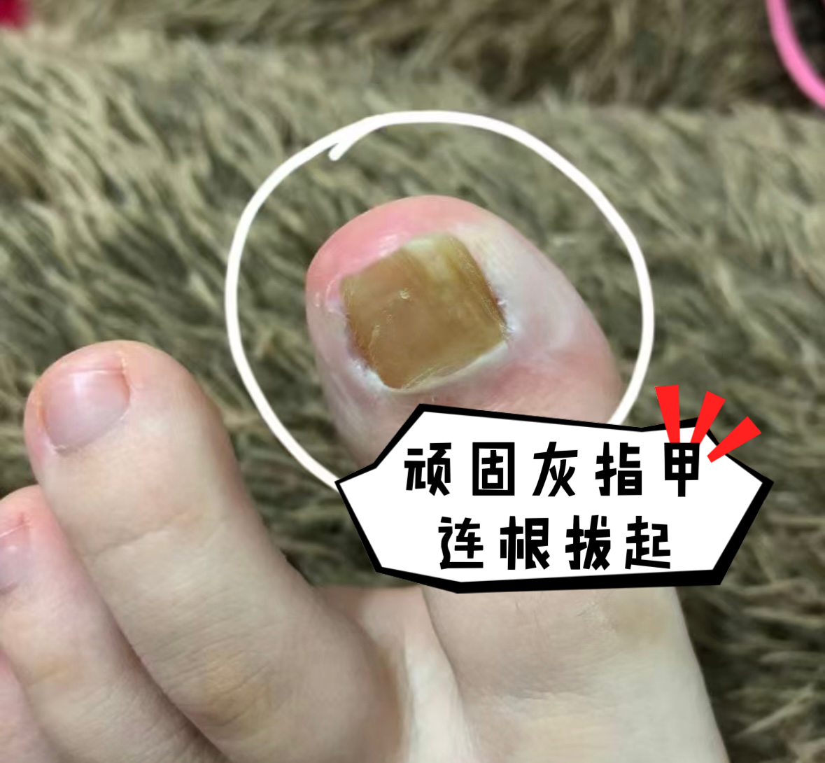 腳趾甲又黃又厚還掉渣?學會這幾招,頑固灰指甲也能連根拔起!