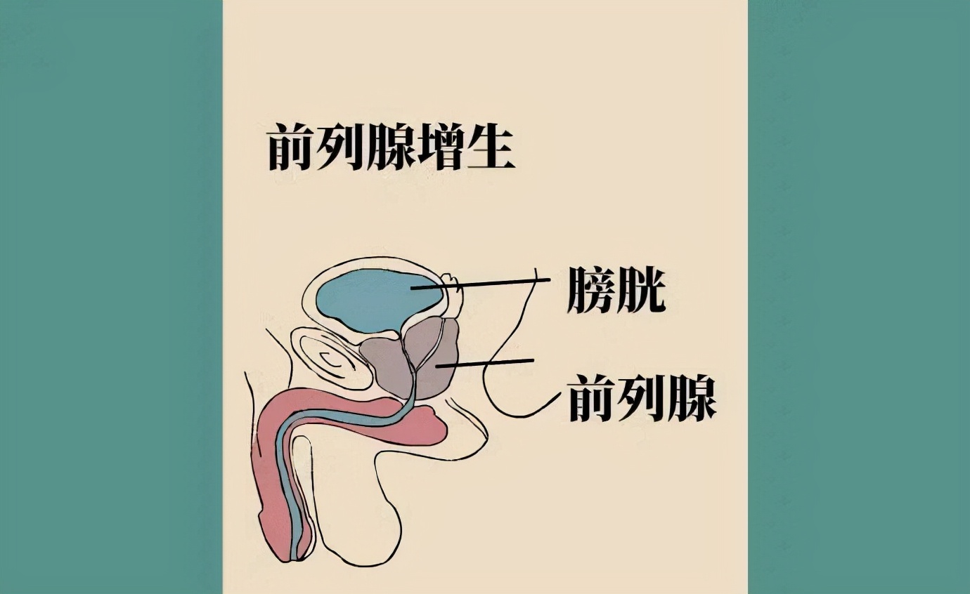 前列腺增生的"苦",很多人都受过,3类常用药物,本文说清楚