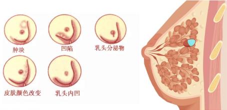 如何进行乳房的自我检查以尽早发现异常?