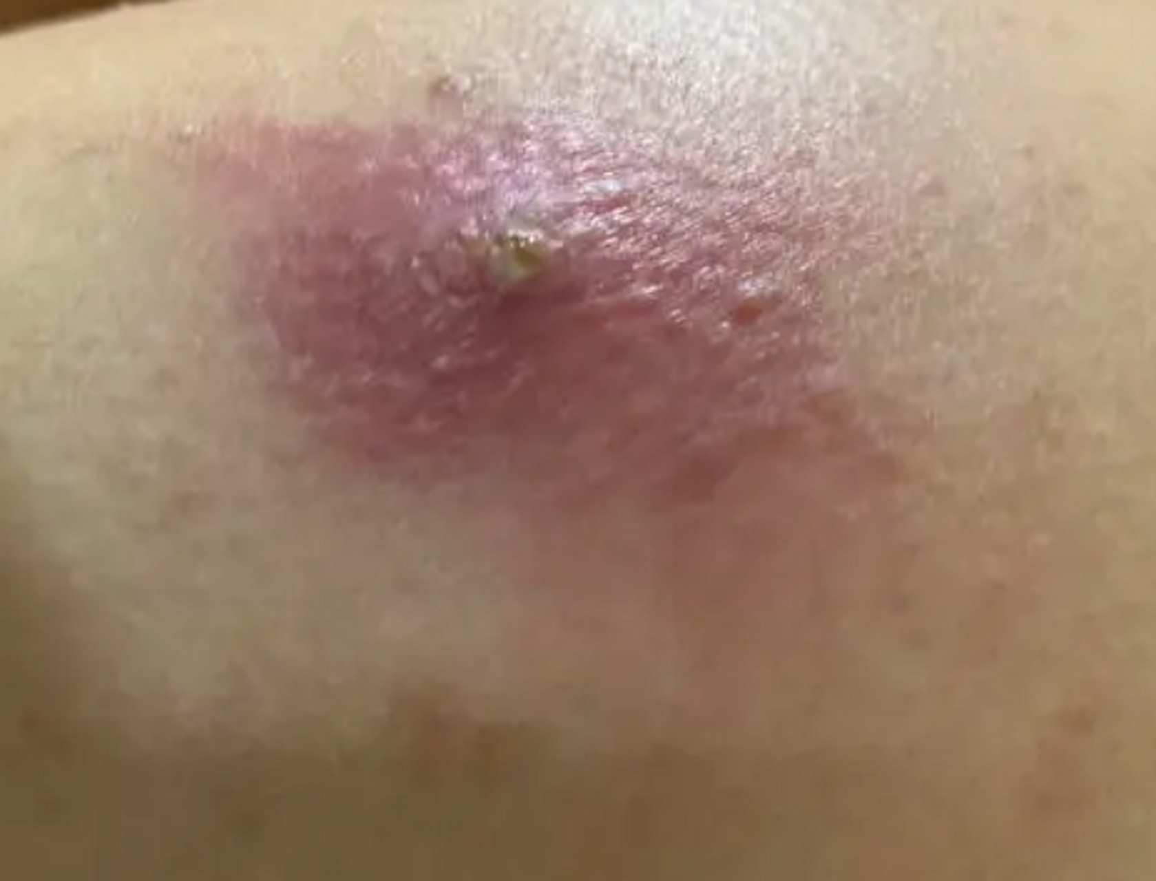 可是四五天之后,大疙瘩破了,开始流脓,粘的后背和衣服上面都是,我们都