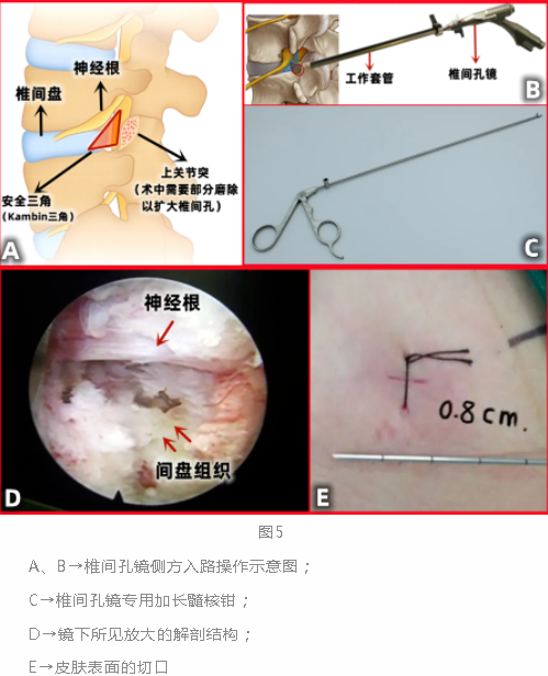 微创手术打孔位置图片图片