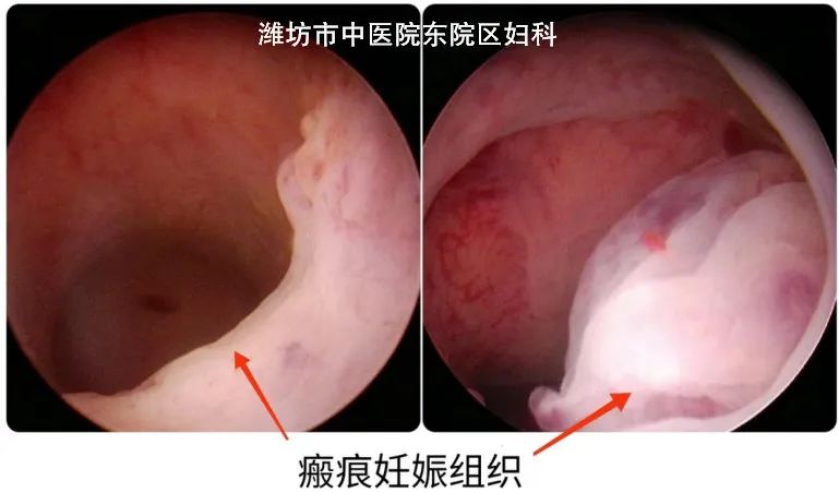 剖宫产瘢痕妊娠?看潍坊市中医院专家如何解决_潍坊新闻_大众网
