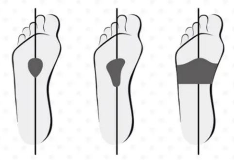 前脚掌有老茧伴有疼痛感怎么办你所不了解的跖痛症