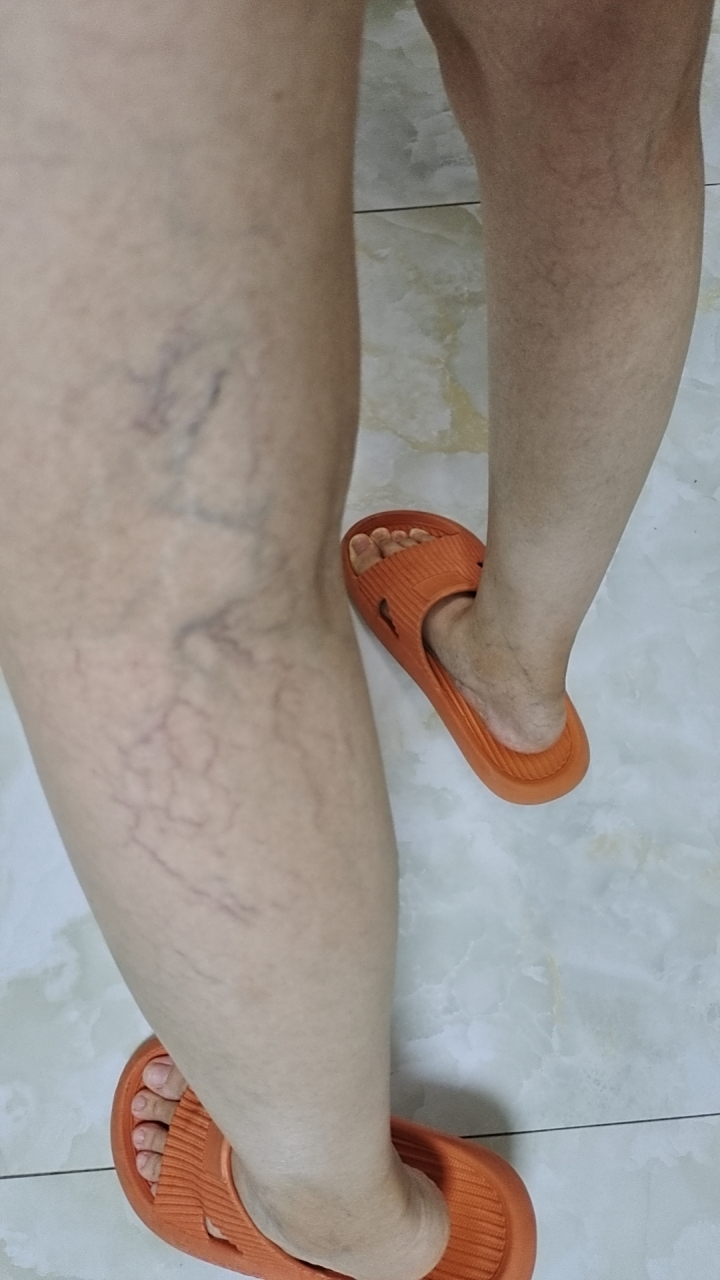 慌了,认为自己下肢静脉曲张了…其实,下肢红血丝,也就是毛细血管扩张