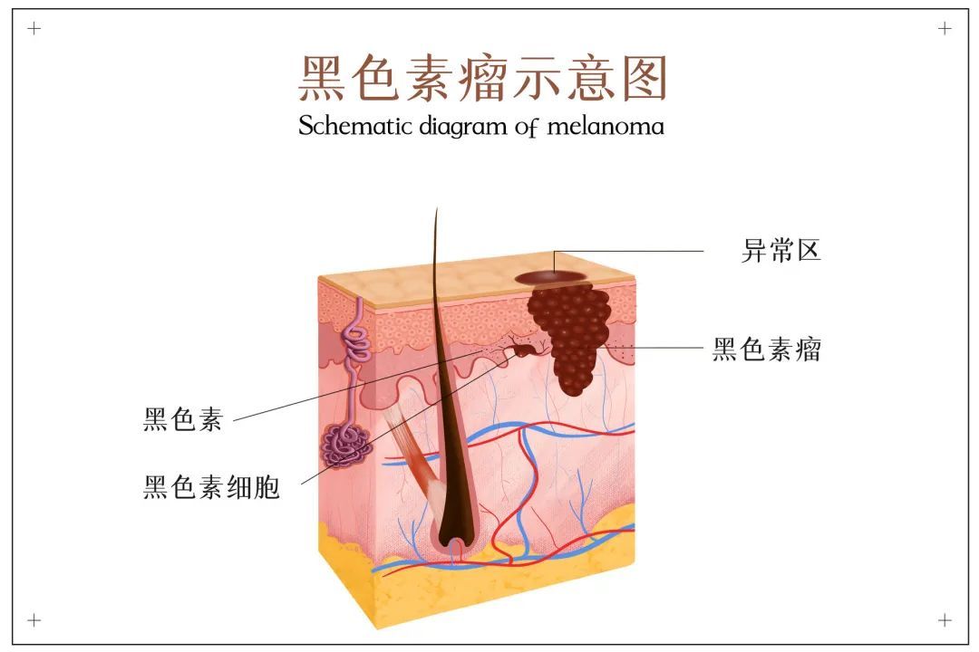 身上的黑点点是痣还是黑色素瘤?