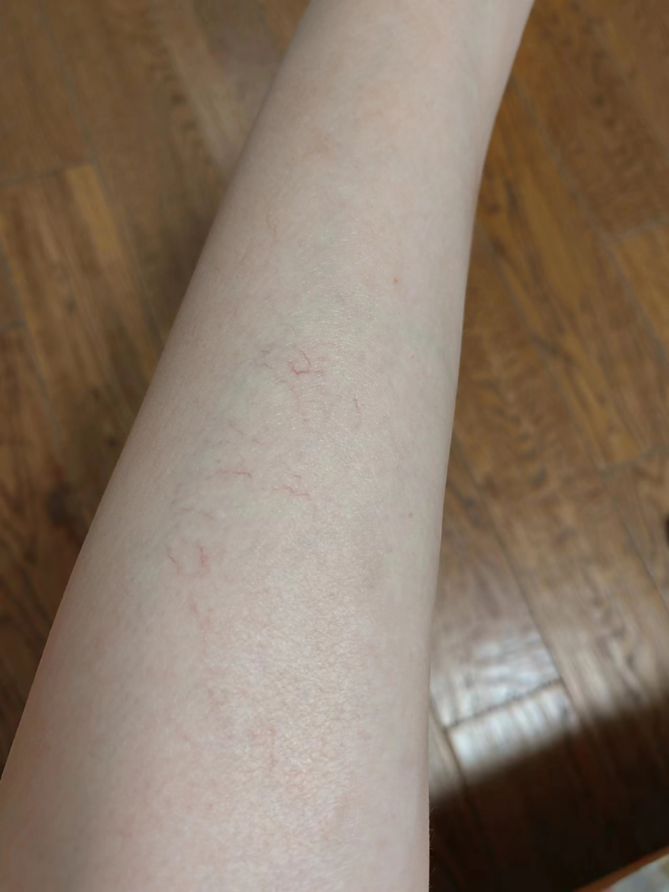 腿上出现红血丝,到底是静脉曲张早期,还是单纯性毛细血管扩张?