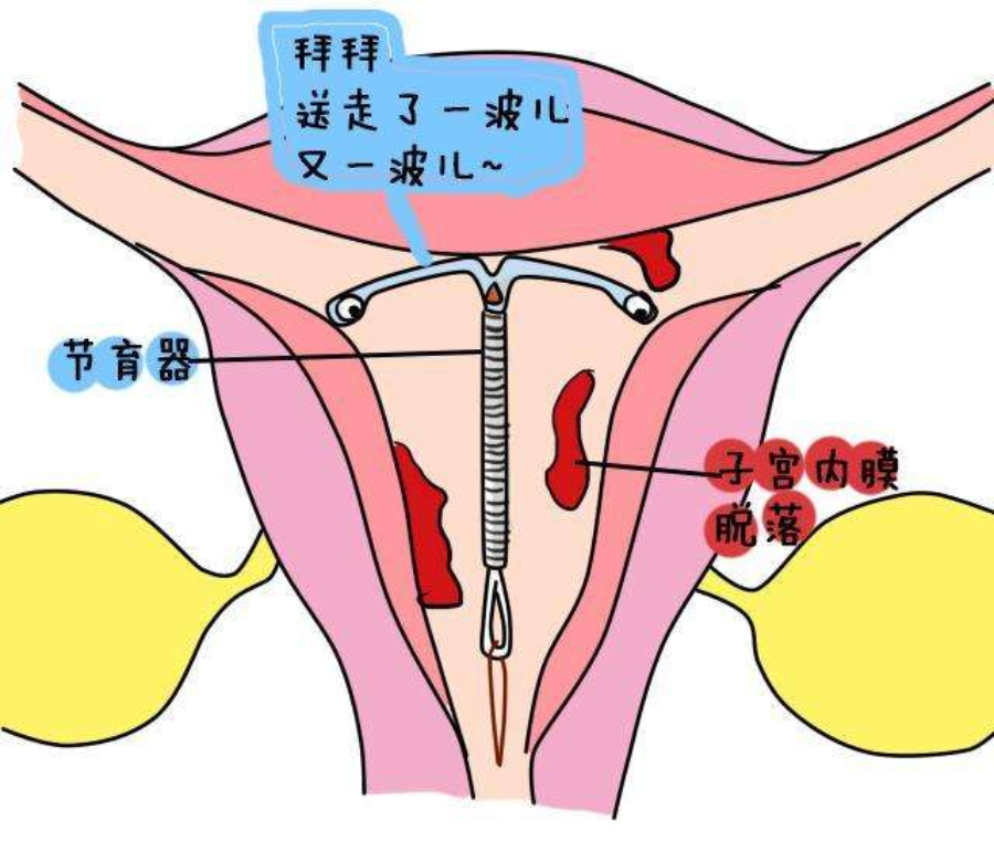 避孕环的位置图片图片