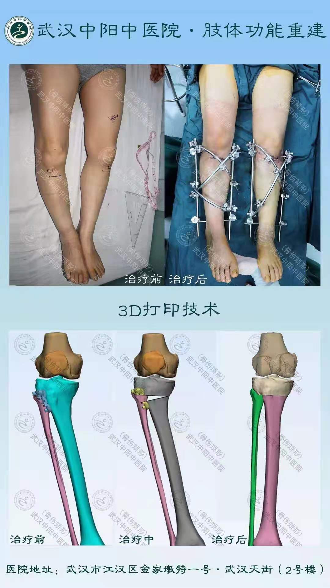 o型腿是骨頭彎了嗎?武漢中陽四維矯形微創矯正,截骨手術矯正