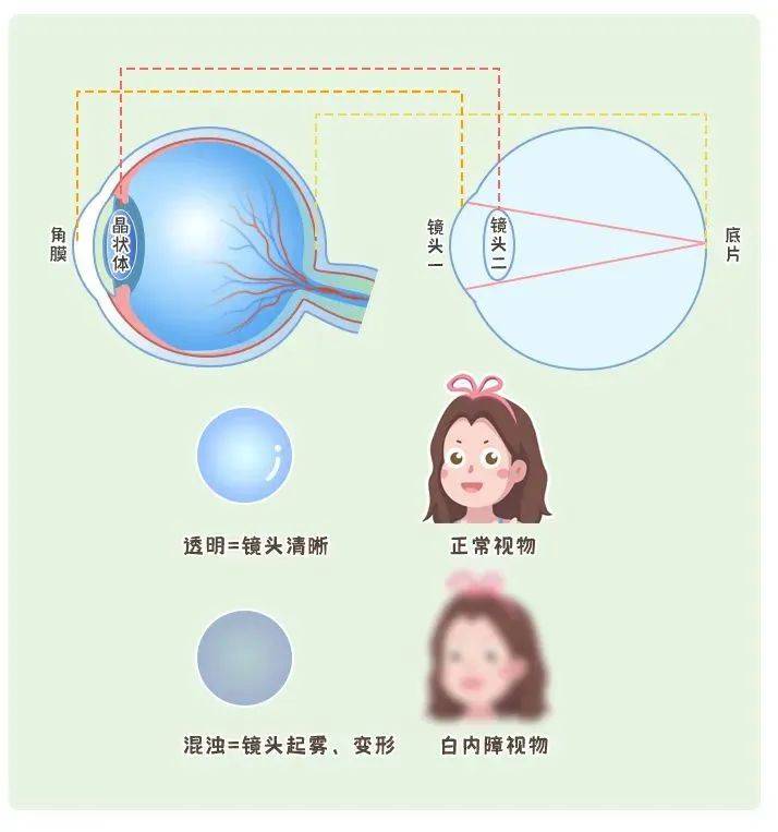 白内障自测图年轻人图片