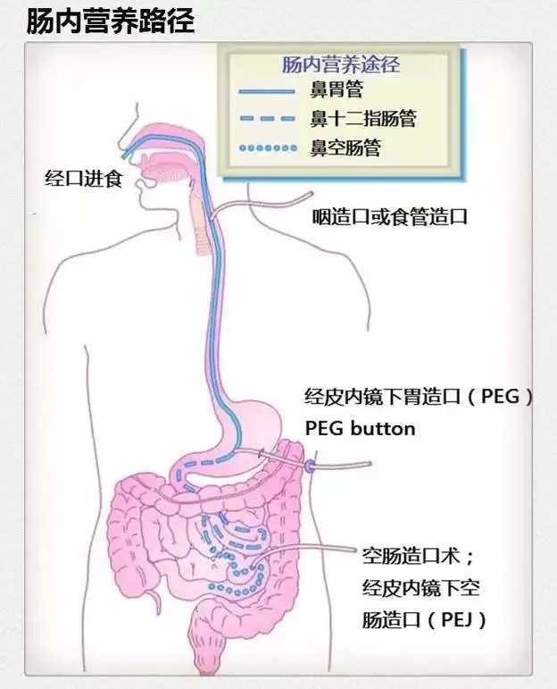 肠梗阻导管 工作原理图片