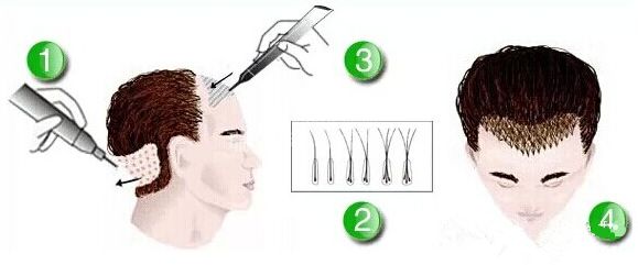 植发麻醉会伤脑子吗?