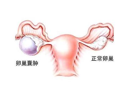 卵巢囊肿 卵泡发育不良,感谢三零三中医院谢素珍让我当上母亲