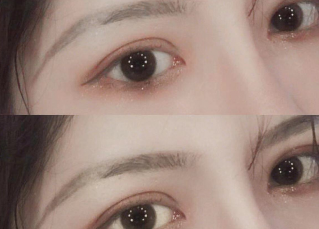 为何双眼皮手术这么受欢迎?你知道吸雕双眼皮的做法和好处吗?