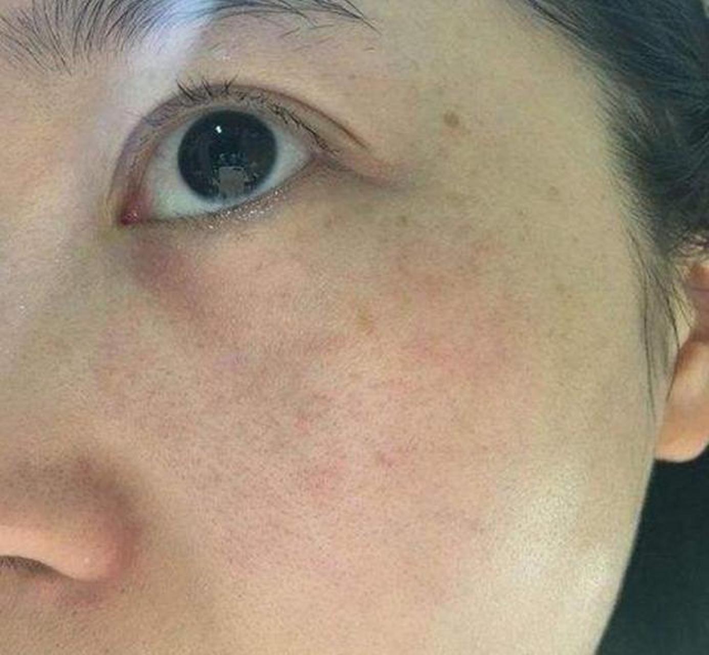 脸上黄褐斑斑怎样去掉 #医美科普挑战赛#   对于我个人来说,脸上的