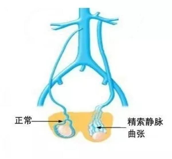 正常的精索静脉图片