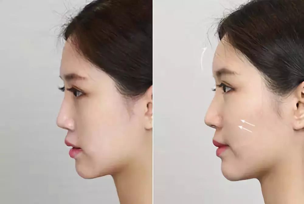 脸上有苹果肌漂亮吗?胶原蛋白填充苹果肌一些常见问题介绍