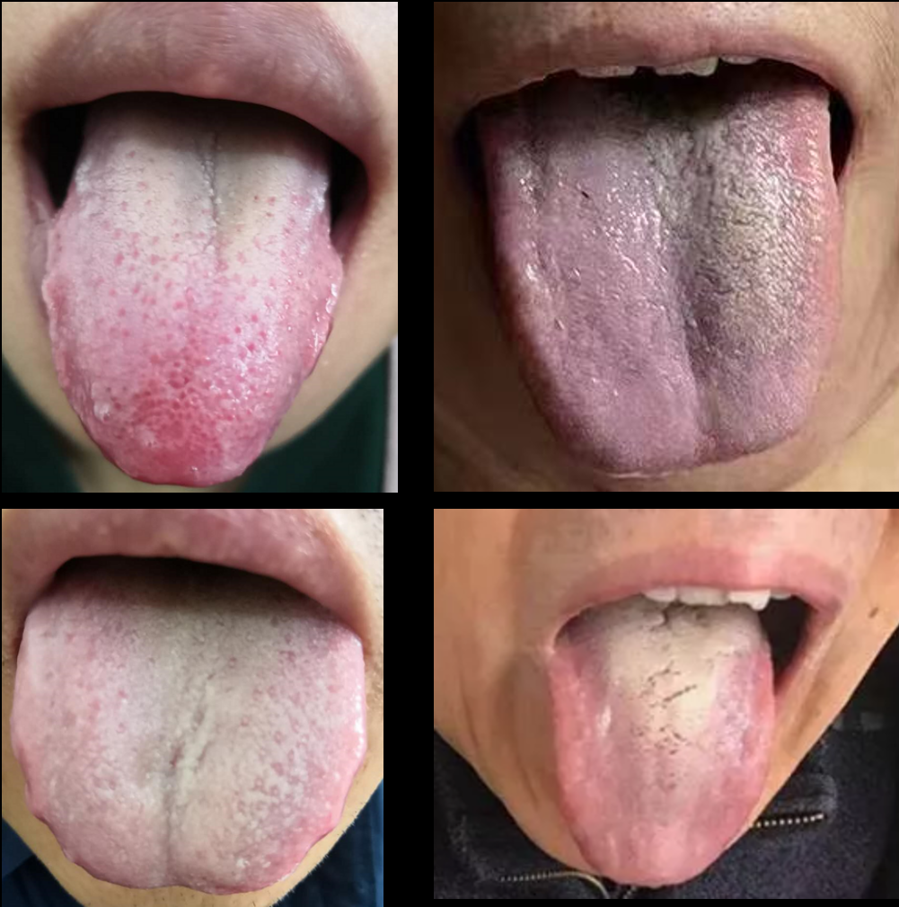 新冠肺炎的极简备药,用药思路:用之前,先看看舌头