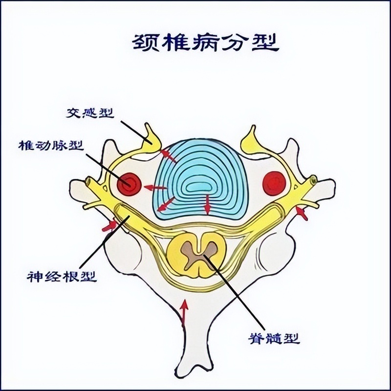 頸椎後縱韌帶骨化是什麼病?是頸椎病嗎?